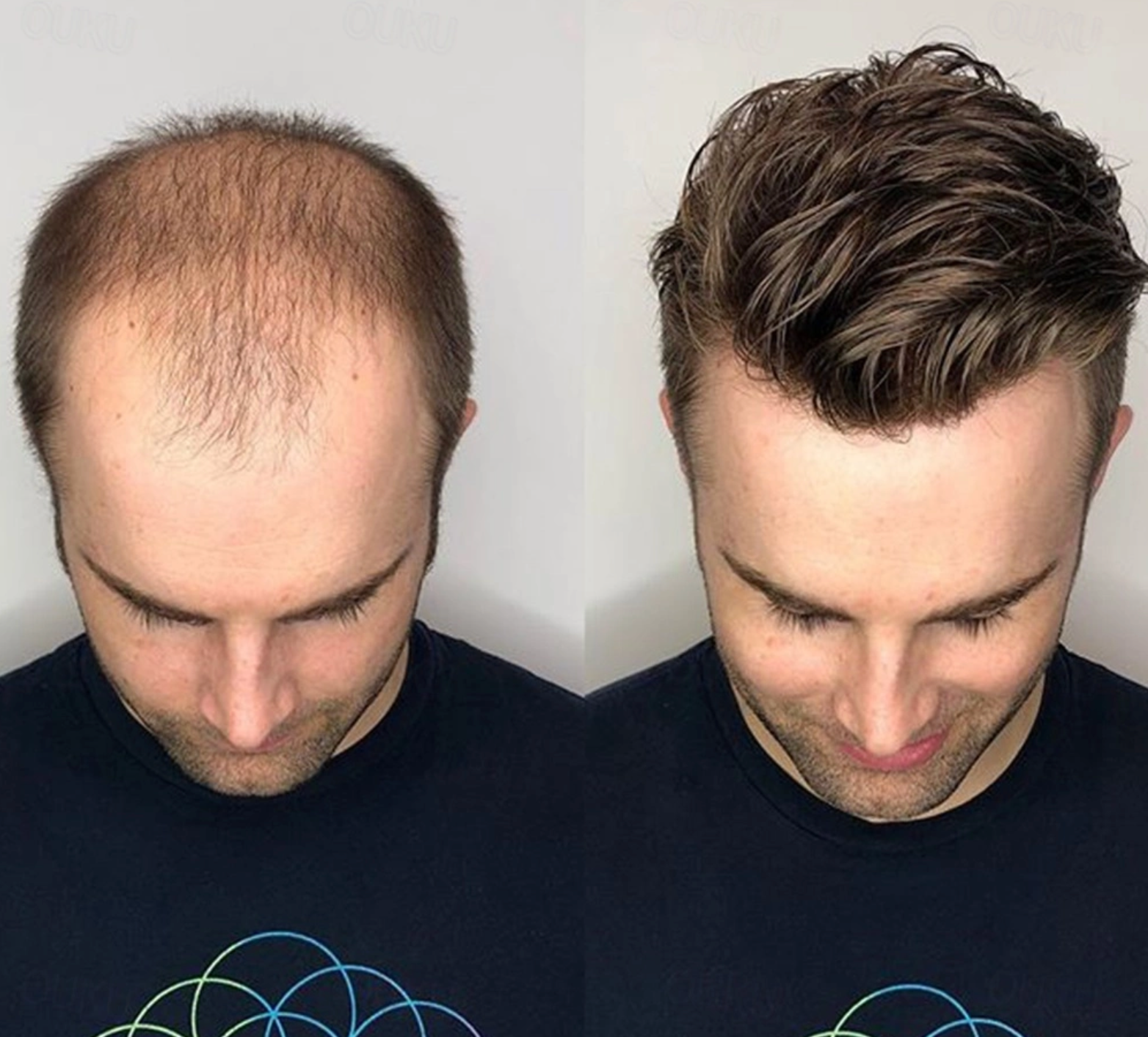 Permanente bevestiging voor heren